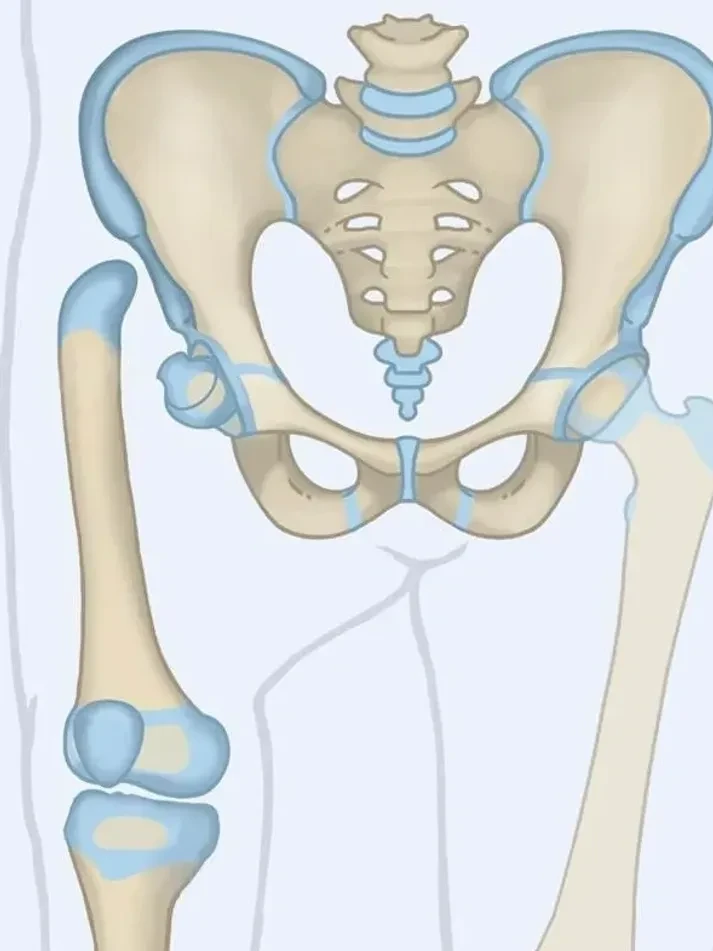 Medical illustration showing Congenital Femoral Deficiency — the pelvis and a shortened, displaced femur on the affected side